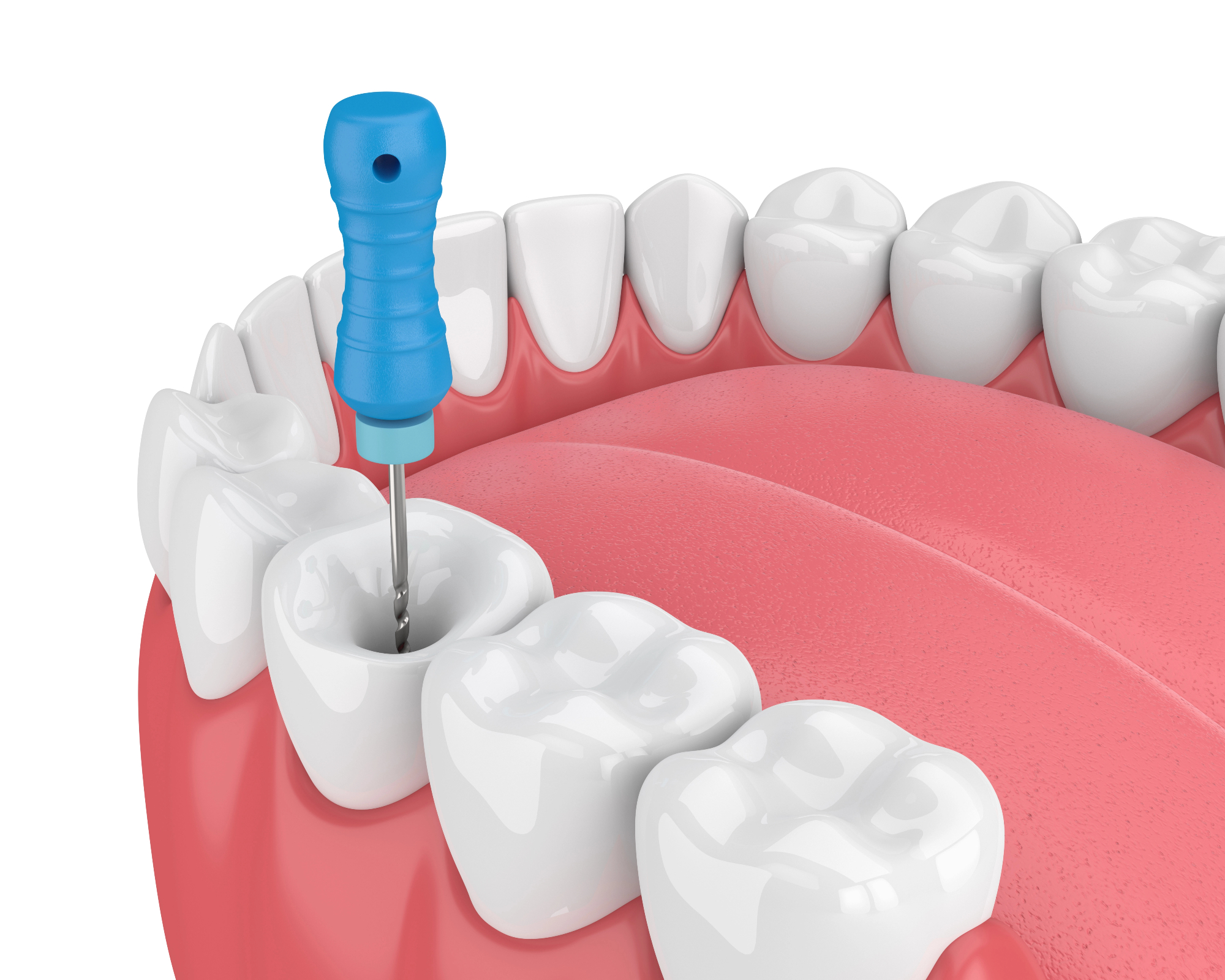 Endodontija in pomen zdravljenja zobnih korenin
